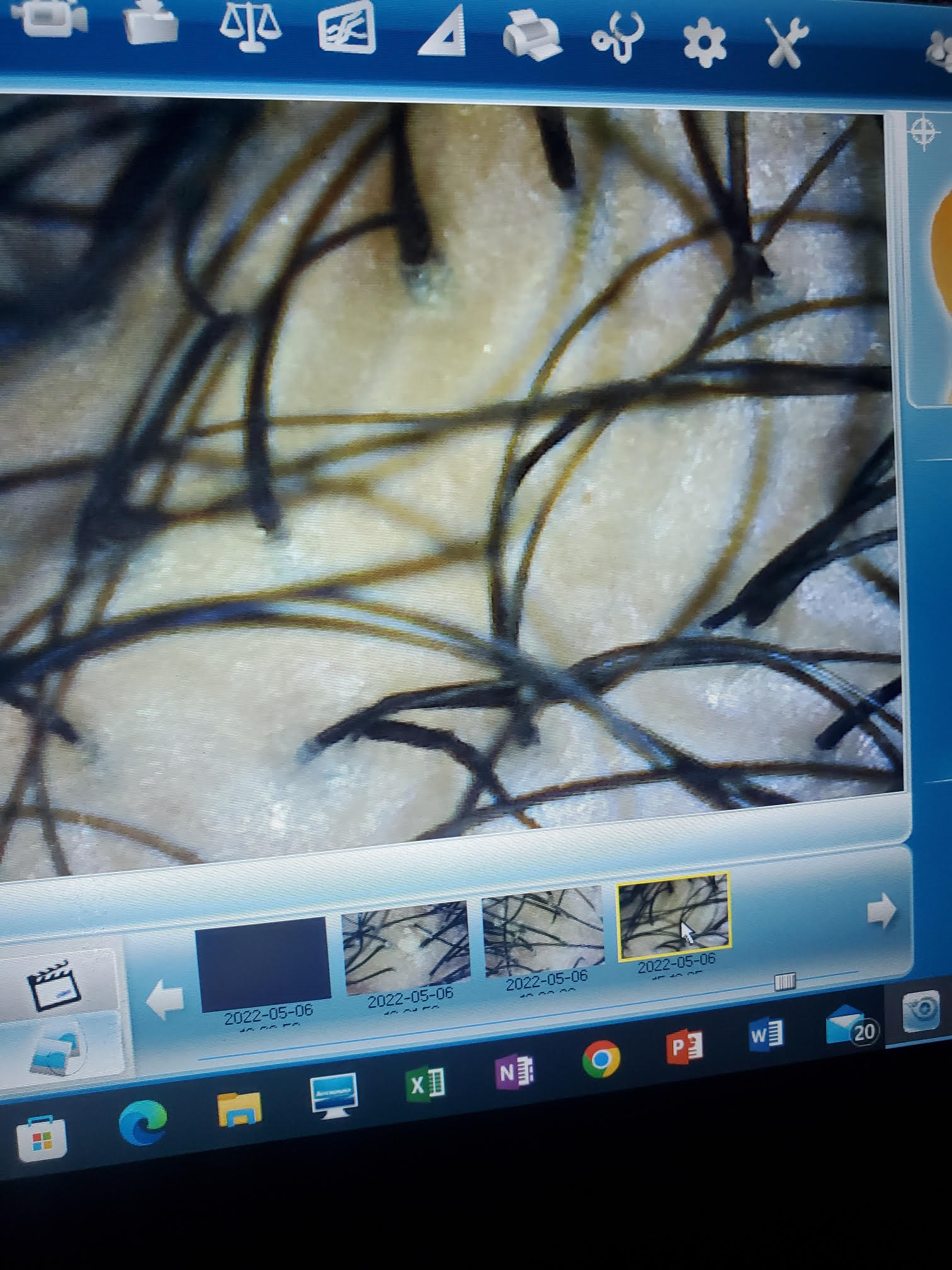 Microscopic scalp analysis process